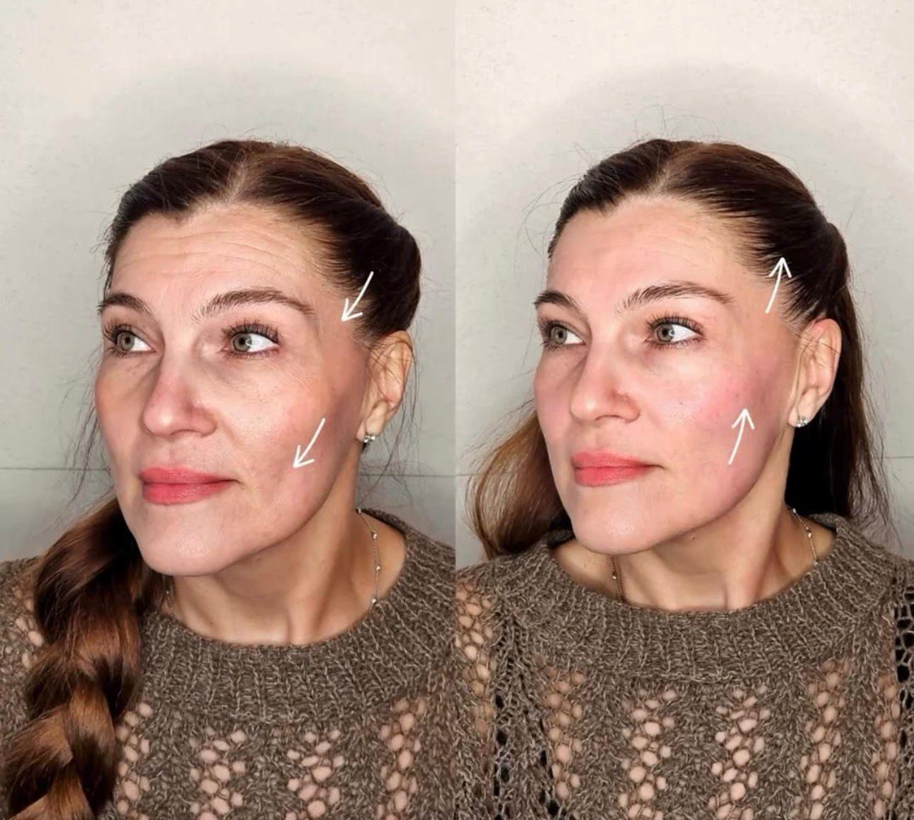 Before and after results of a non-surgical HIFU facial lift at Blend Beauty Artisans, Capel Street, Dublin 1